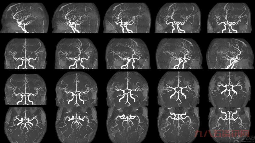 什么是伪t2信号？这篇文章让你秒懂！